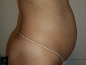 Laser Liposuction Before and After Pictures Washington, DC