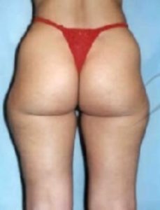 Liposuction Before and After Pictures Washington, DC