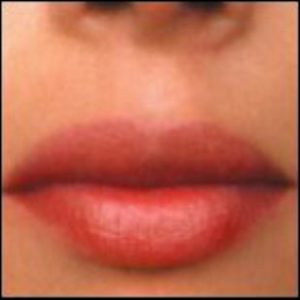 Lip Enhancement Before and After Pictures Washington, DC