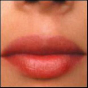 Lip Enhancement Before and After Pictures Washington, DC