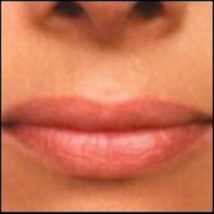 Lip Enhancement Before and After Pictures Washington, DC