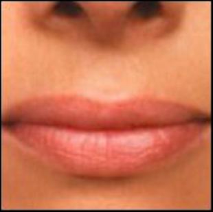 Lip Enhancement Before and After Pictures Washington, DC