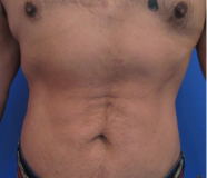 Liposuction Before and After Pictures Washington, DC