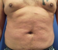 Liposuction Before and After Pictures Washington, DC