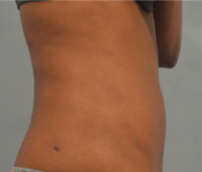 Liposuction Before and After Pictures Washington, DC