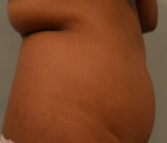 Liposuction Before and After Pictures Washington, DC