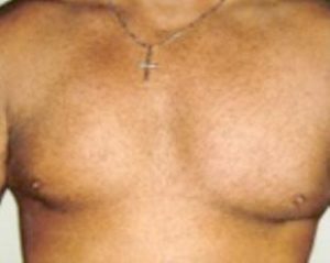 Male Breast Reduction Before and After Pictures Washington, DC