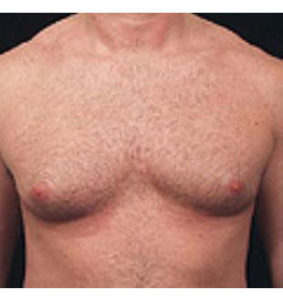 Male Breast Reduction Before and After Pictures Washington, DC