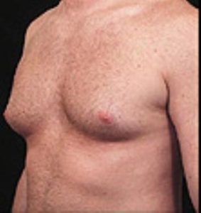 Male Breast Reduction Before and After Pictures Washington, DC