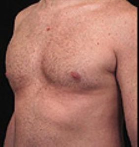 Male Breast Reduction Before and After Pictures Washington, DC