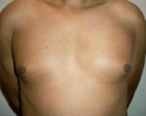 Male Breast Reduction Before and After Pictures Washington, DC