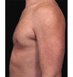 Male Breast Reduction Before and After Pictures Washington, DC