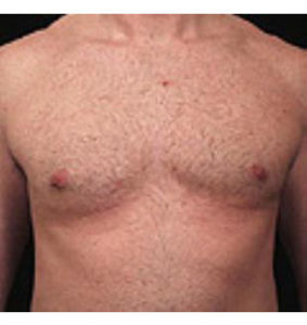 Male Breast Reduction Before and After Pictures Washington, DC