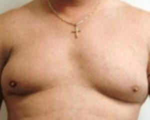 Male Breast Reduction Before and After Pictures Washington, DC