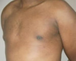 Male Breast Reduction Before and After Pictures Washington, DC