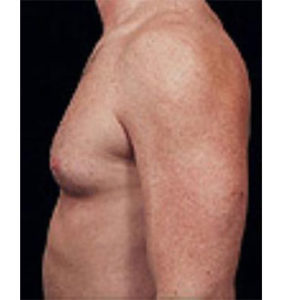 Male Breast Reduction Before and After Pictures Washington, DC