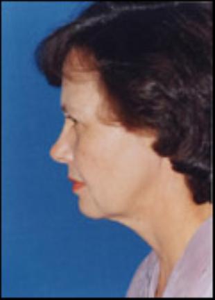 Neck Lift Before and After Pictures Washington, DC