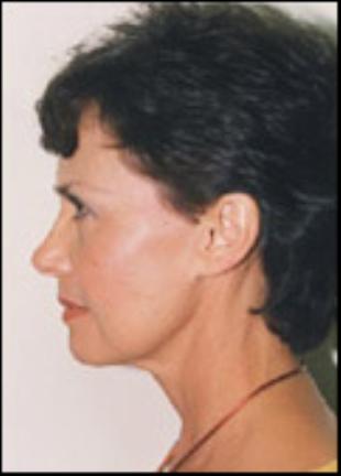 Neck Lift Before and After Pictures Washington, DC