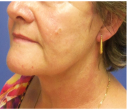 Neck Lift Before and After Pictures Washington, DC