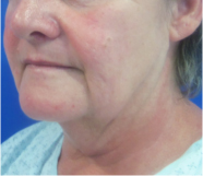 Neck Lift Before and After Pictures Washington, DC