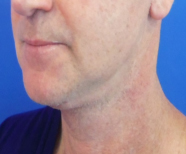 Neck Lift Before and After Pictures Washington, DC