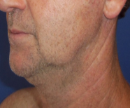 Neck Lift Before and After Pictures Washington, DC