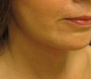 Neck Lift Before and After Pictures Washington, DC