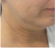 Neck Lift Before and After Pictures Washington, DC