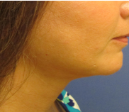 Neck Lift Before and After Pictures Washington, DC