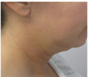 Neck Lift Before and After Pictures Washington, DC