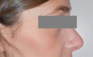 Rhinoplasty Before and After Pictures Washington, DC