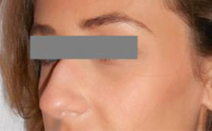 Rhinoplasty Before and After Pictures Washington, DC