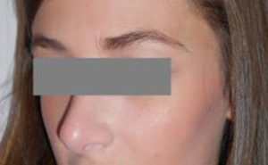 Rhinoplasty Before and After Pictures Washington, DC