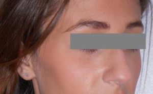 Rhinoplasty Before and After Pictures Washington, DC