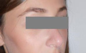 Rhinoplasty Before and After Pictures Washington, DC