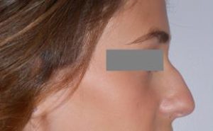 Rhinoplasty Before and After Pictures Washington, DC