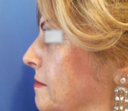 Rhinoplasty Before and After Pictures Washington, DC