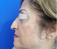 Rhinoplasty Before and After Pictures Washington, DC