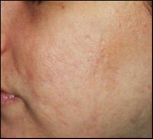Scar Revision Before and After Pictures Washington, DC