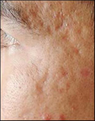 Scar Revision Before and After Pictures Washington, DC