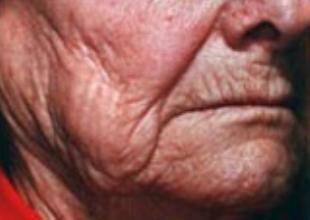 Skin Resurfacing Before and After Pictures Washington, DC