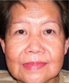 Skin Resurfacing Before and After Pictures Washington, DC