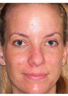 Skin Resurfacing Before and After Pictures Washington, DC