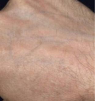 Sun Damage Before and After Pictures Washington, DC