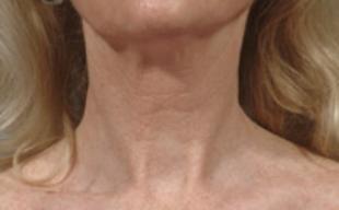 Sun Damage Before and After Pictures Washington, DC