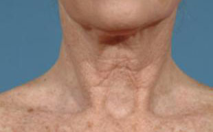 Sun Damage Before and After Pictures Washington, DC