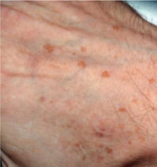 Sun Damage Before and After Pictures Washington, DC