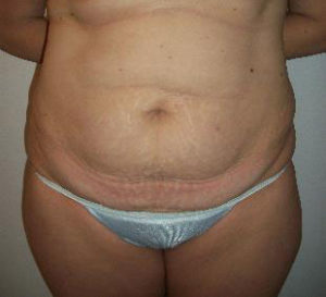 Tummy Tuck Before and After Pictures Washington, DC