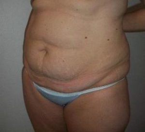 Tummy Tuck Before and After Pictures Washington, DC