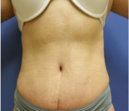 Tummy Tuck Before and After Pictures Washington, DC